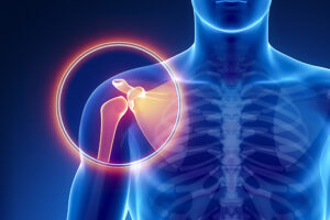 Articulación Acromio-Clavicular