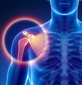 Articulación Acromio-Clavicular