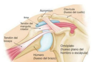 Tendinitis calcificada del manguito rotador de hombro
