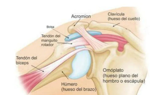 Tendinitis calcificada del manguito rotador de hombro